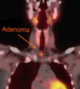 Medical scan image indicating the presence of an adenoma.