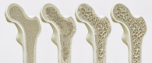 Progression of bone density loss from normal to severe osteoporosis.