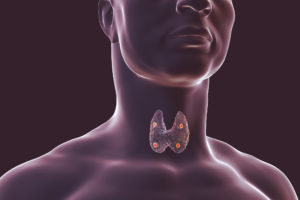 Digital medical illustration showing a human thyroid gland with nodules.