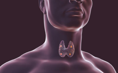 Digital medical illustration showing a human thyroid gland with nodules.