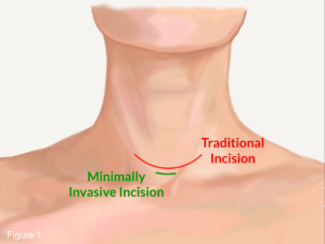 minimally invasive incision for parathyroidectomy