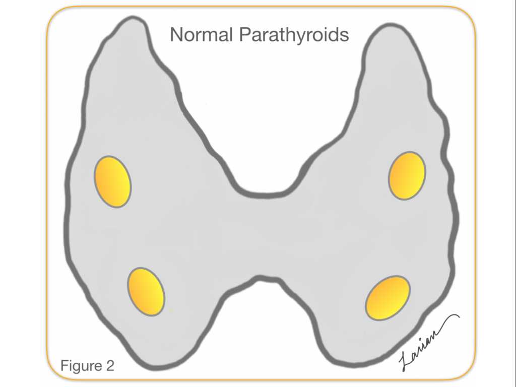 Parathyroid Gland Location Dr Larian Hyperparathyroid