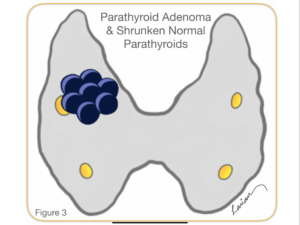 parathyroid adenoma and shrunken normal parathyroids