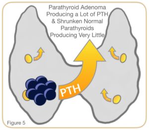 parathyroid adenoma producing a lot of PTH