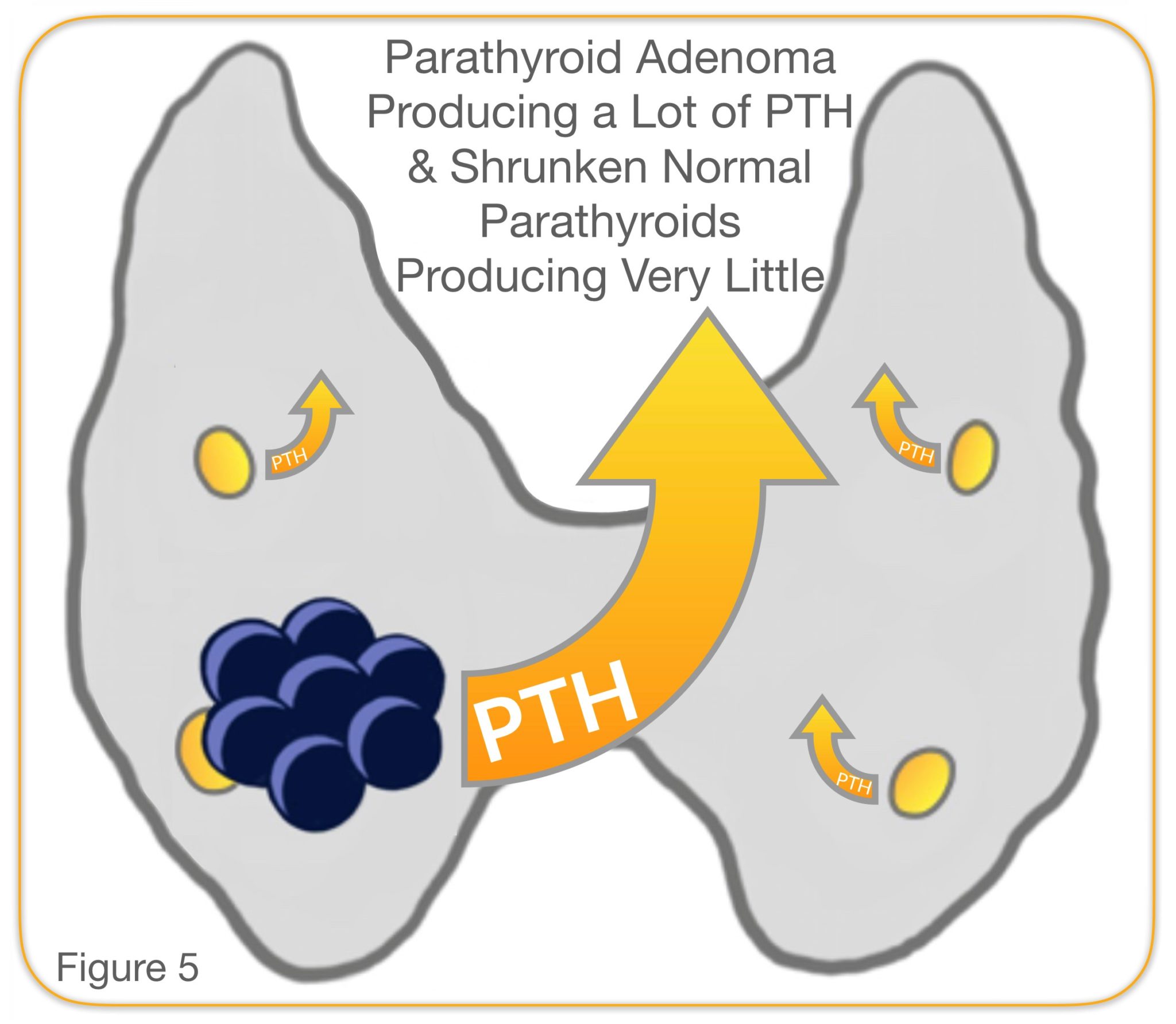 Parathyroidectomy Parathyroid Gland Removal Surgery Dr Larian