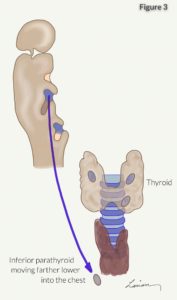 inferior parathyroid moving farther into chest