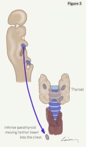 inferior parathyroid moving farther into chest