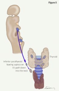 inferior parathyroid leaving piece in neck