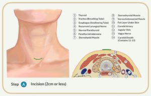 parathyroidectomy anatomy steps