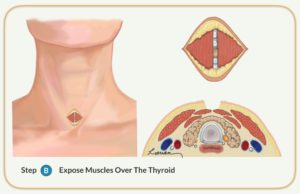 parathyroidectomy expose muscles