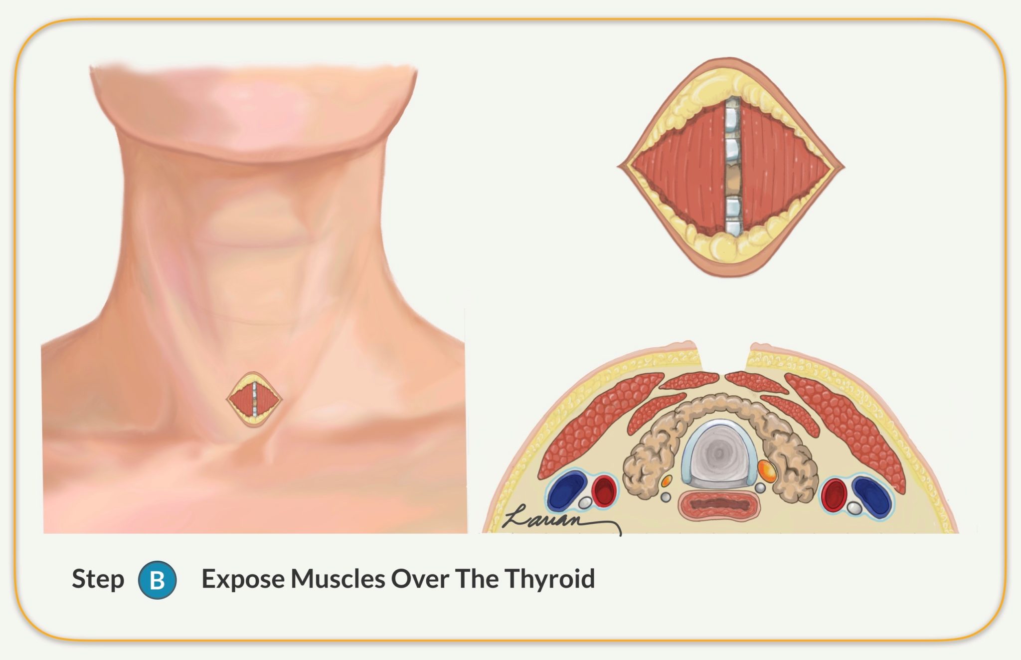 parathyroidectomy expose muscles