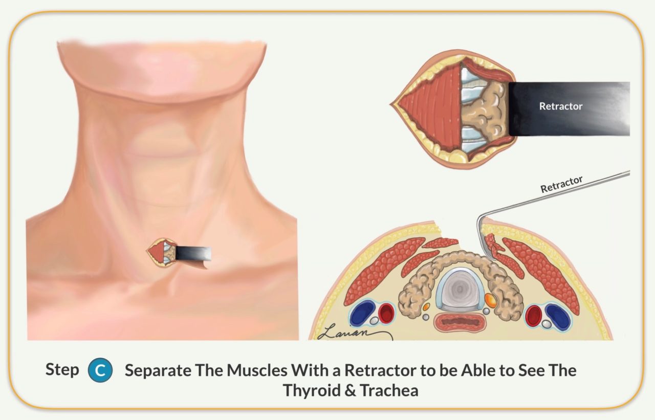 Parathyroidectomy Parathyroid Gland Removal Surgery Dr. Larian