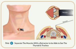 parathyroidectomy separate muscles with retractor