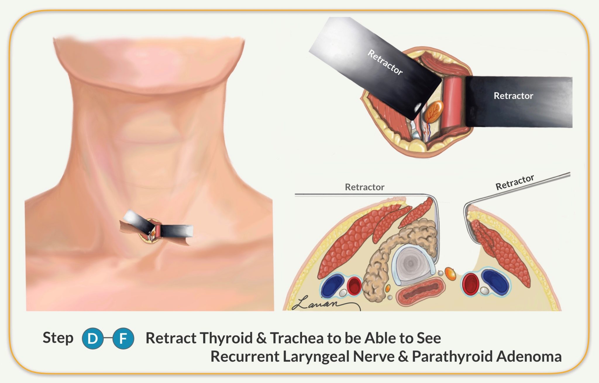 parathyroidectomy retract thyroid and trachea