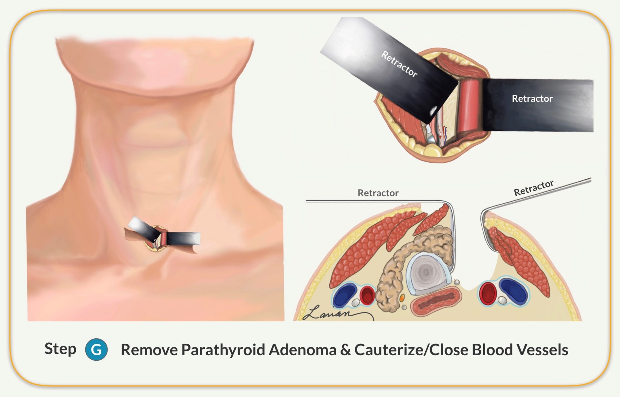remove parathyroid adenoma