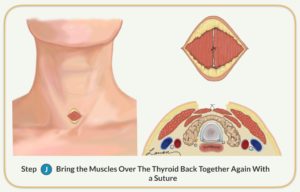 bring muscles over thyroid back together suture