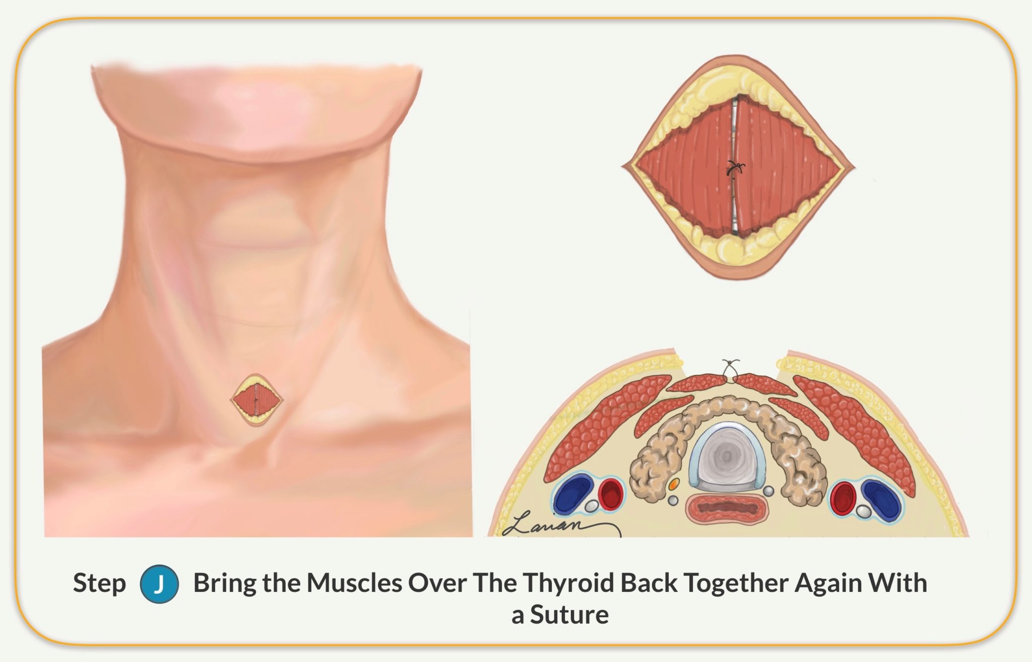 bring muscles over thyroid back together suture