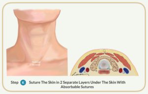 suture skin parathyroidectomy