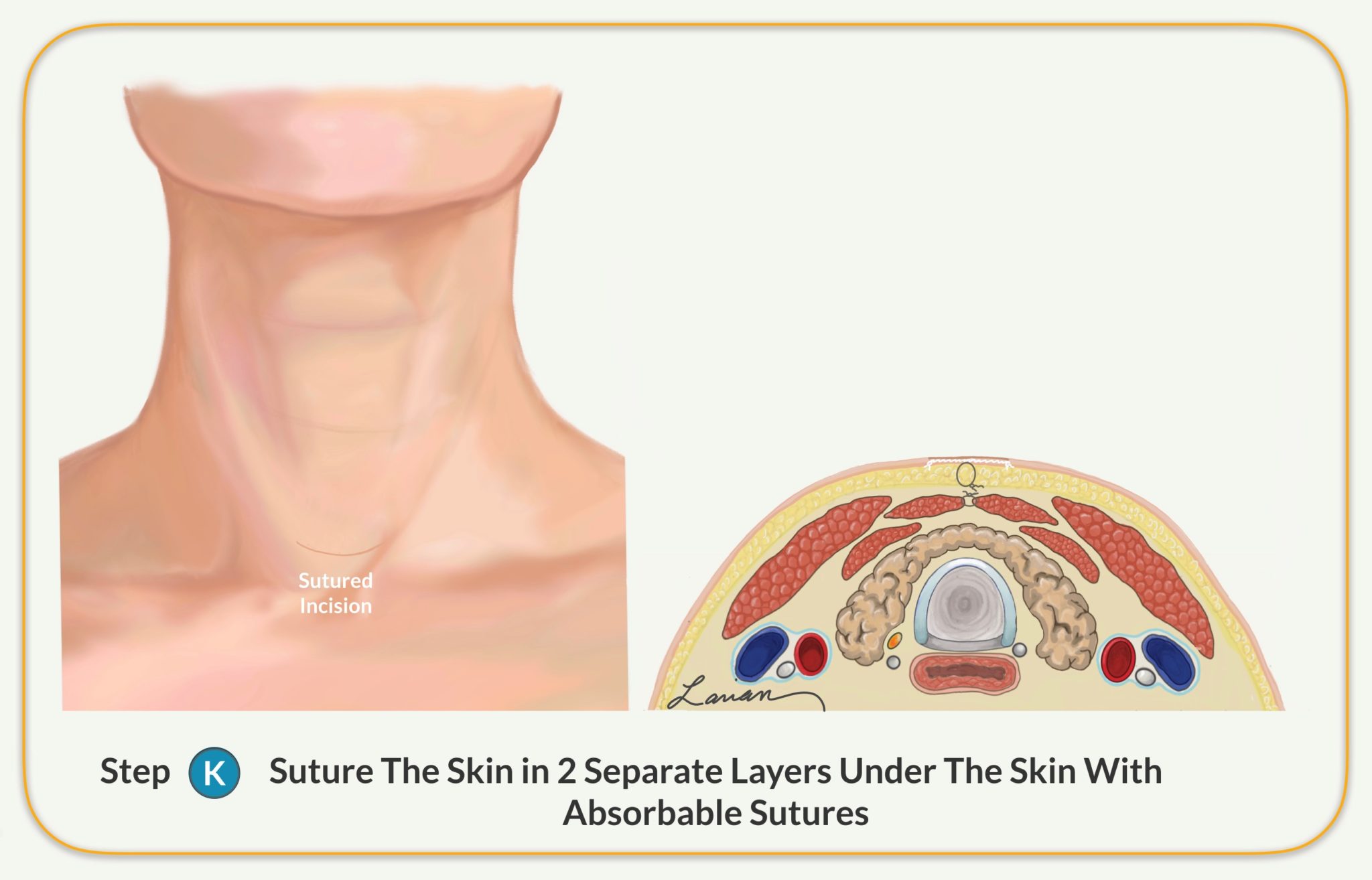 suture skin parathyroidectomy