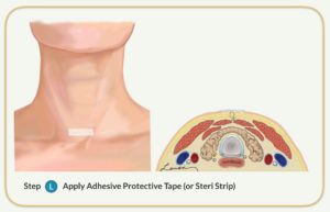 adhesive protective tape parathyroidectomy