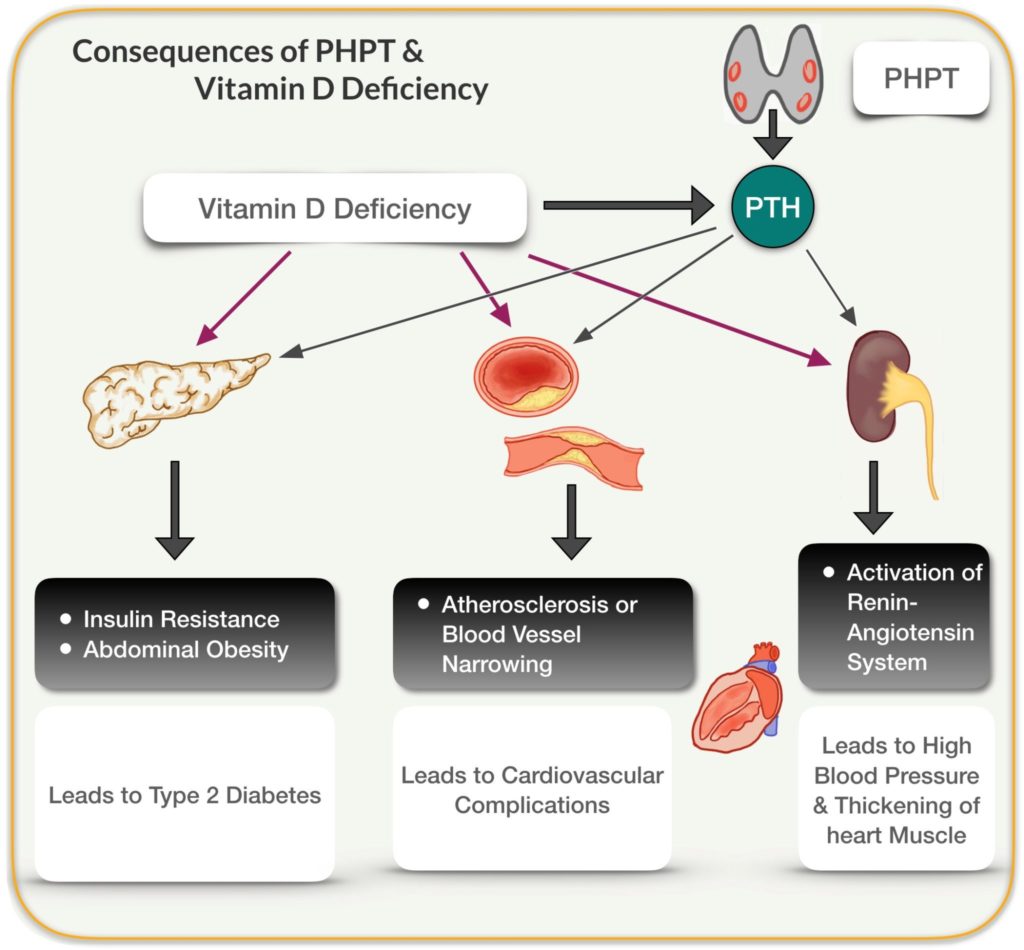 vocaal Articulatie schuur Hyperparathyroidism and Vitamin D | Dr. Babak Larian