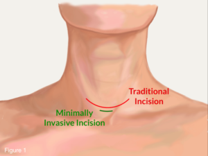 Medical illustration comparing minimally invasive and traditional incision locations on the neck.