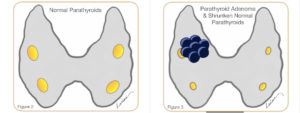 Comparative diagrams of normal parathyroid glands and parathyroid glands with adenomas and other abnormalities.