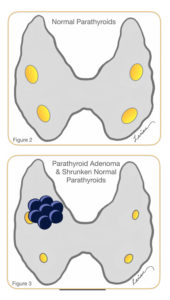 Illustrations comparing normal parathyroid glands to a parathyroid adenoma with shrunken normal glands.