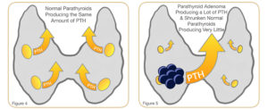 figure 4 and 5 showing normal parathyroids vs parathyroid adenoma