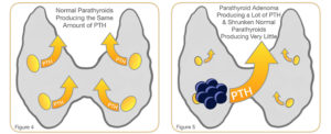 Two diagrams comparing normal parathyroid glands with balanced PTH production and a parathyroid adenoma with increased PTH production and atrophied normal glands.