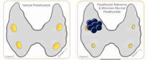 Illustration comparing normal parathyroid glands to a parathyroid adenoma with shrunken normal parathyroids.