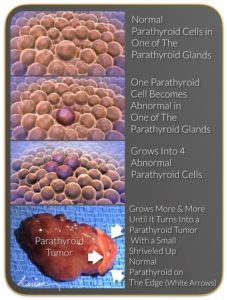 Educational illustration showing the progression of normal parathyroid cells into a parathyroid tumor with an actual tumor specimen at the bottom.