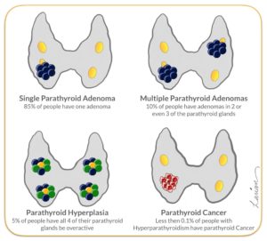Illustration showing four types of parathyroid conditions: single adenoma, multiple adenomas, hyperplasia, and cancer, with percentage occurrences.