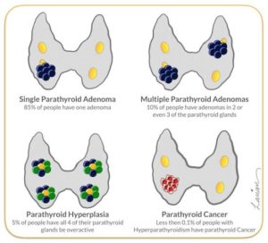 Parathyroid Adenomoa vs Hyperplasia