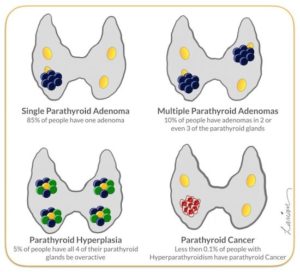 Illustrative chart showing four types of parathyroid conditions: single adenoma, multiple adenomas, hyperplasia, and cancer.