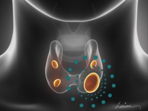 Illustration of hyperactive parathyroid glands with calcium molecules in the bloodstream.