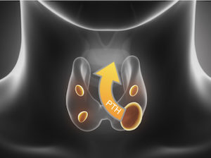 Illustration of an overactive parathyroid gland producing excess PTH.