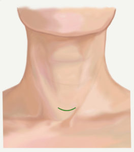 Illustration showing the neck of a person with the incision line for thyroid surgery marked.