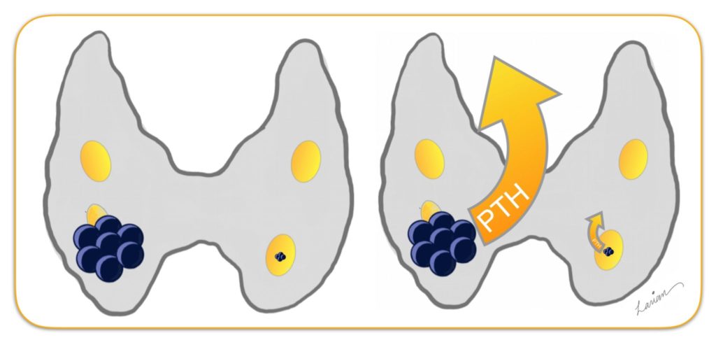 Large Parathyroid Adenoma PTH