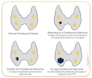 Parathyroid Adenoma Growth