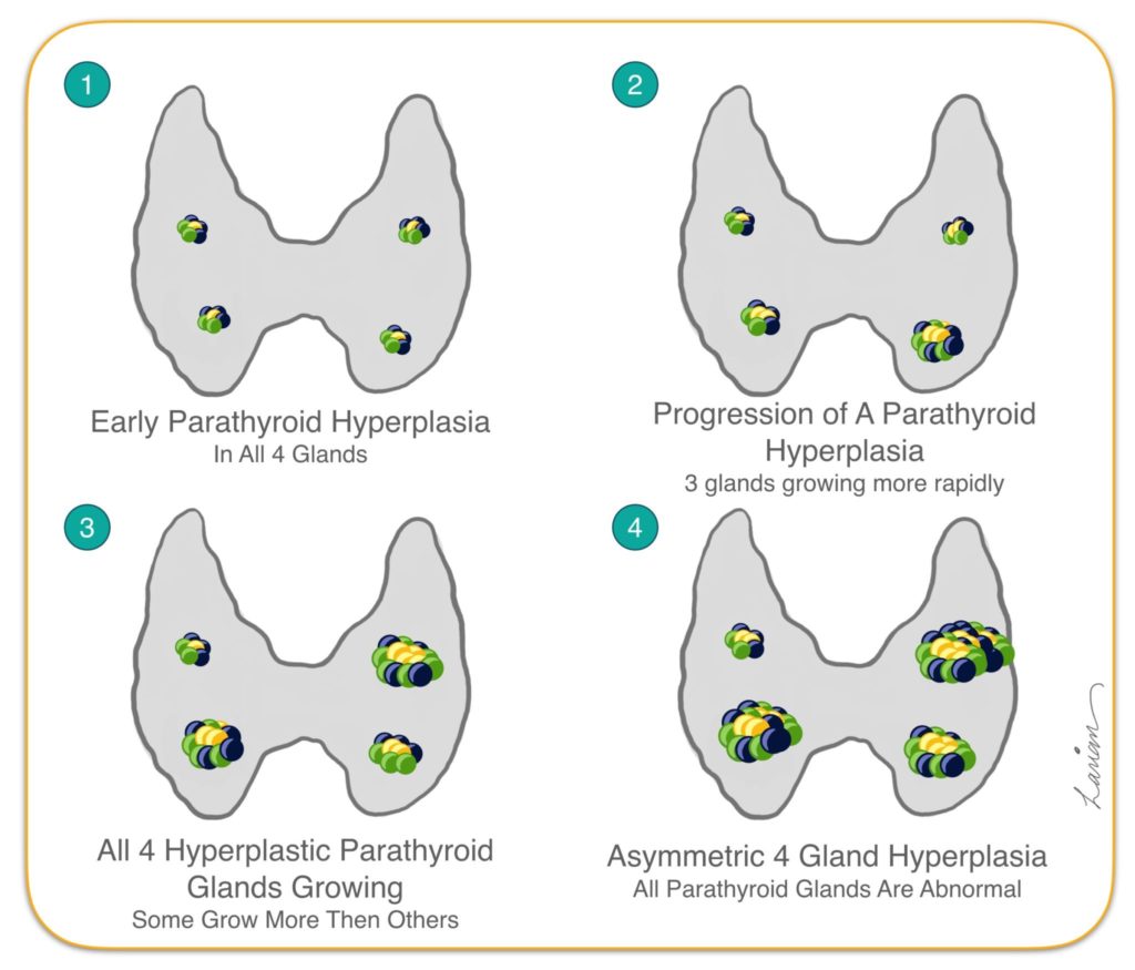 Parathyroid Hyperplasia Growth