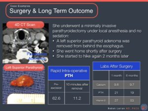 Medical case study slide showing a 4D CT scan, a removed left superior parathyroid adenoma, and lab results pre- and post-surgery for a patient with parathyroidectomy.