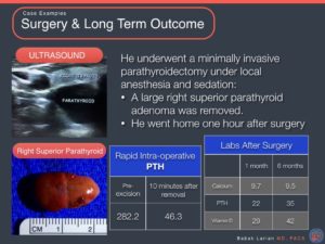 Medical presentation slide showing parathyroid surgery and long-term outcome with ultrasound and specimen images, and post-surgery lab results.