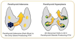 Parathyroid Adenoma and Hyperplasia Glands Producing PTH