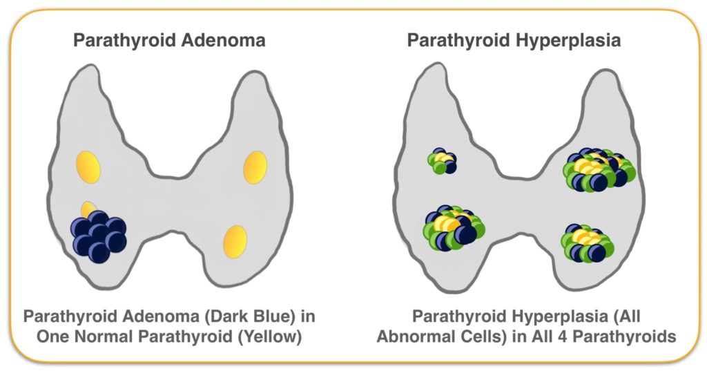 Parathyroid Adenoma and Hyperplasia Graphic