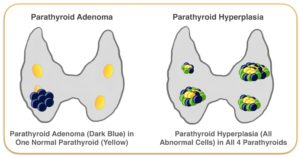 Parathyroid Adenoma and Hyperplasia Graphic