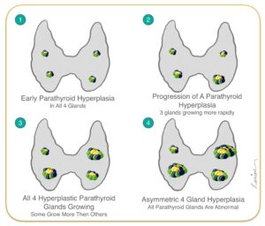 Parathyroid Hyperplasia Growth in Cells of Parathyroid Gland