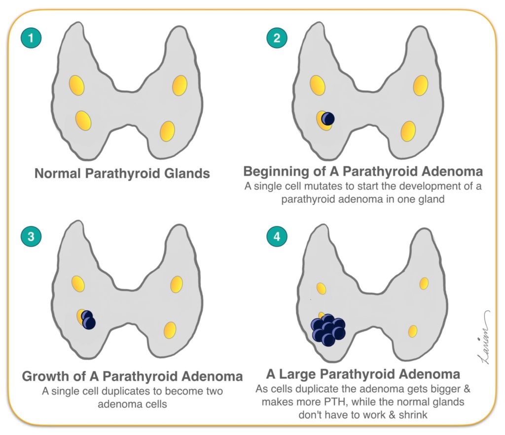 Intraoperative Parathyroid Hormone Pth Testing Dr Larian