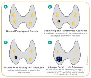 Parathyroid Adenoma Growth Progression