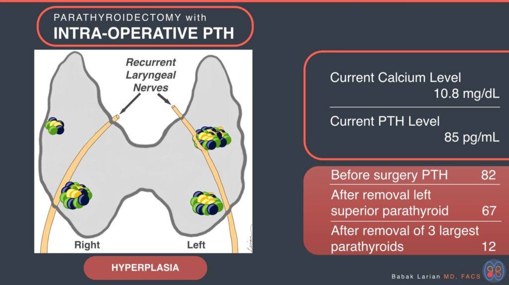 Parathyroidectomy with intra-operative PTH Hyperplasia